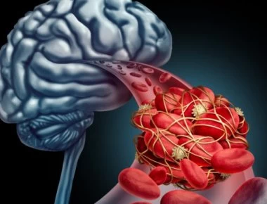 Ανεύρυσμα εγκεφάλου: Μην αγνοήσετε τα «αθώα» πρώιμα συμπτώματα